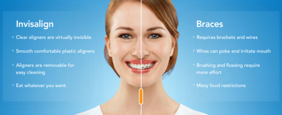 invisalign comparison