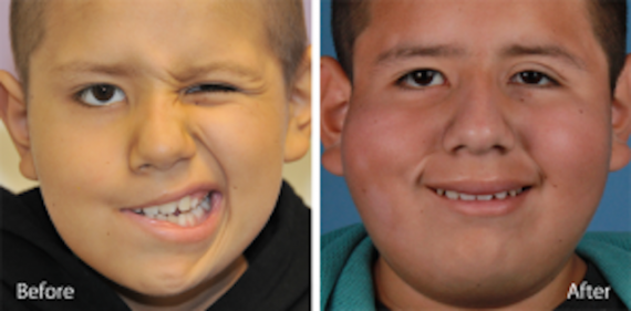 Andre-Panossian-facial-paralysis-pediatric-plastic-surgeon-beverly-hills-california